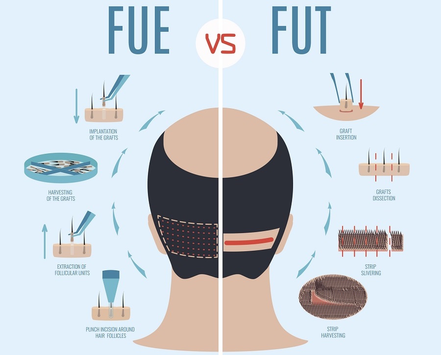 FUT and FUE Hair Transplant Burlington